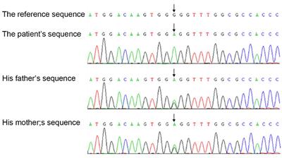 A TYK2 Gene Mutation c.2395G>A Leads to TYK2 Deficiency: A Case Report and Literature Review